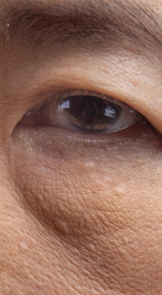 HR Plastic Sugery - Droopy eyelids - Eyelid bags - Loose excess eyelid skin